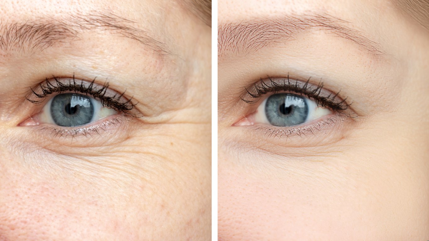 Under Eye Wrinkles Prevent and Treat Fine Lines Under Eyes 8